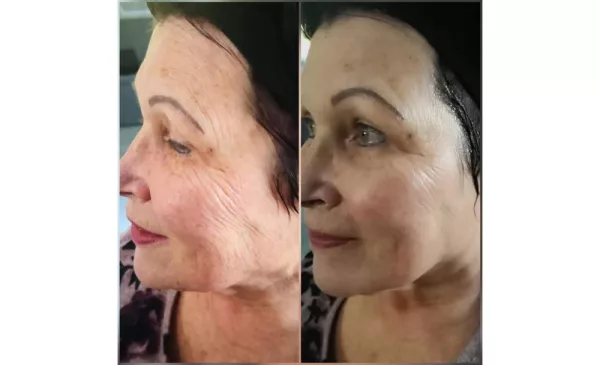 Reduce Signs of Aging with a Galvanic Face Lift - Image 3
