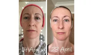 Galvanic face lift