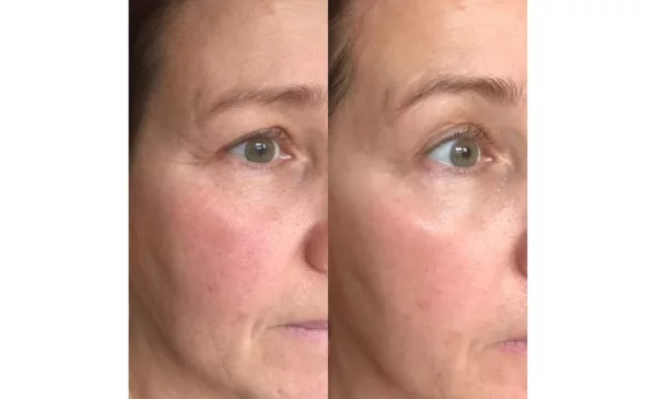 Reduce Signs of Aging with a Galvanic Face Lift - Image 2