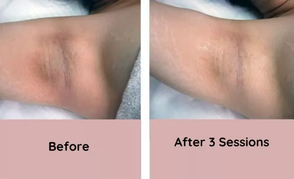 Reduce dark spots caused by hyperpigmentation with IPL Laser