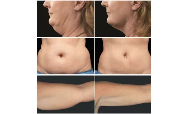 Burn stubborn fat with a fat freeze session in Gardens - Image 5