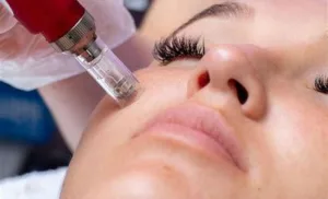microneedling