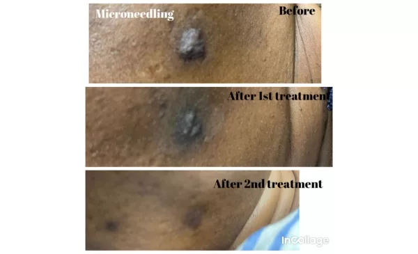 Even your skin tone with this microneedling offer in Johannesburg - Image 4
