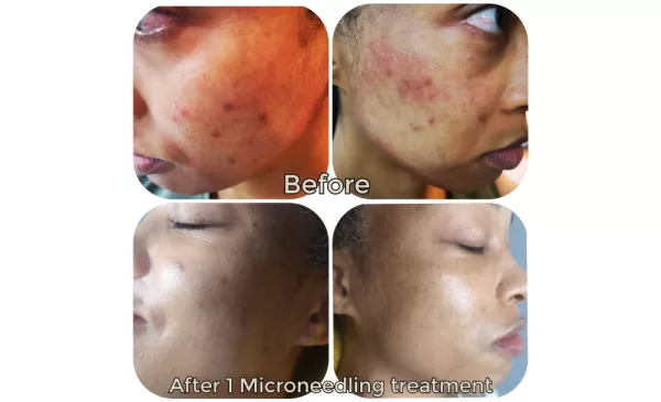 Even your skin tone with this microneedling offer in Johannesburg - Image 3