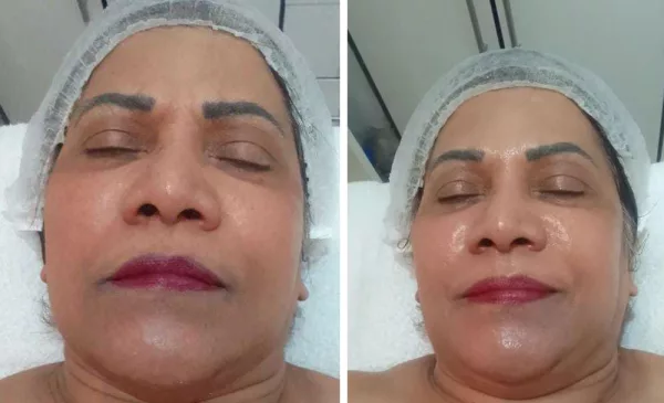 Get Hydrated, Radiant Skin with a 60-Minute Dermafix Facial - Image 2