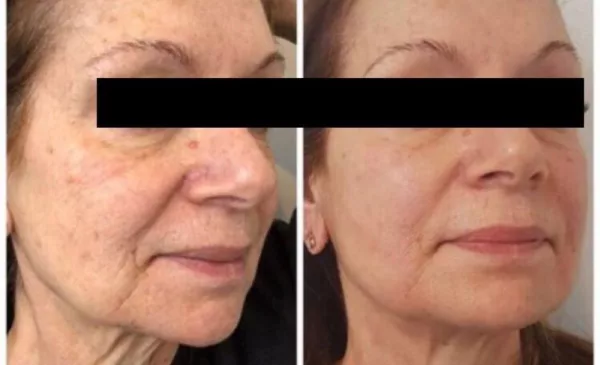 A HIFU Non-Surgical Facelift to Reduce Signs of Ageing - Image 2