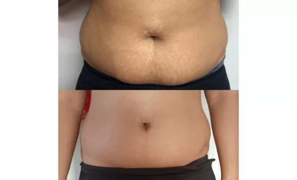 Speed Up Your Weight Loss Journey with Fat Freezing - Image 4