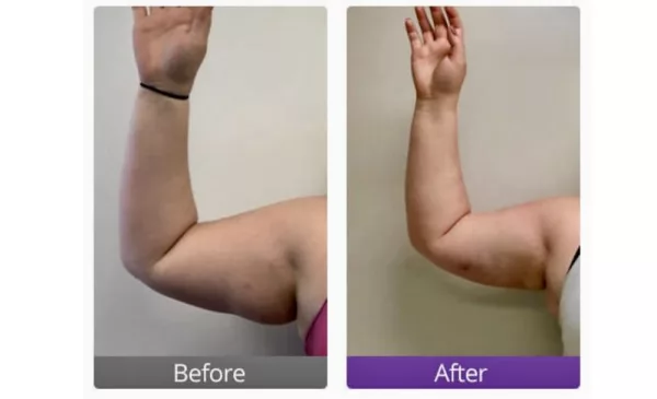 Shape Up with a Summer Slimming Treatment Package - Image 3