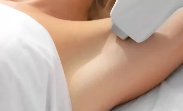 laser hair removal