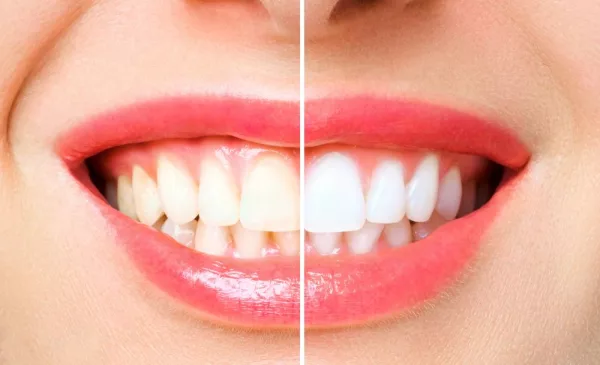Brighten Up Your Smile with a Teeth Whitening Session